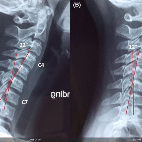 Cervical Kyphosis Before And After Chiropractic Adjustment A Sagittal