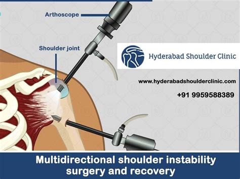 Multidirectional Shoulder Instability Surgery And Recovery Shoulder