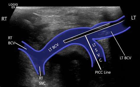 Upper Extremity Venous Doppler Sonographic Tendencies Vascular Ultrasound Radiology Imaging