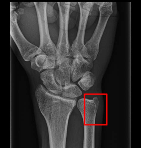 Avulsion Fracture Of Styloid Process Of Ulna
