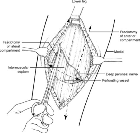 Cosm Fasciotomy Fasciectomy For Chronic Exertional Compartment Syndrome