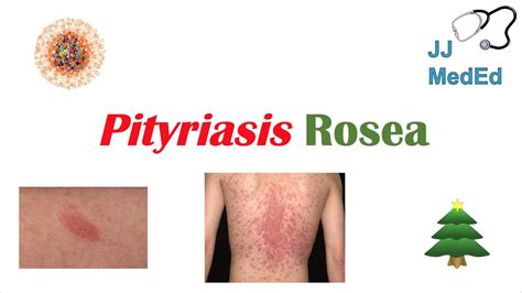 Pityriasis Rosea Treatment Cream