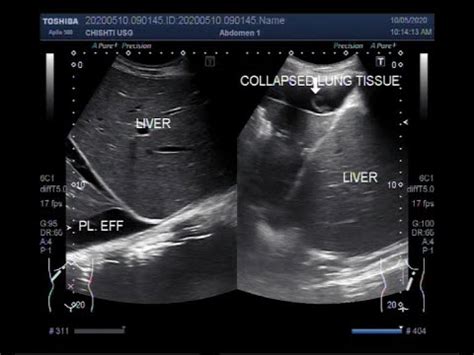 Pleural effusion is classically divided into transudate and exudate based on the light criteria. Ultrasound Video showing Atelectasis , Pleural Effusion ...