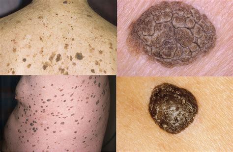 Many — But Not All — Skin Lesions Are Harmless