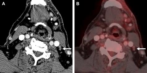 Pitfalls In The Staging Of Cervical Lymph Node Metastasis