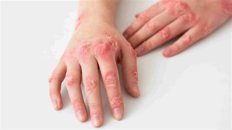 10 Common Skin Diseases With Photos Health Service Navigator