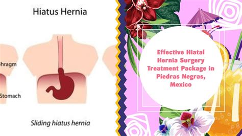Effective Hiatal Hernia Surgery Treatment Package In Piedras Negras Mexico
