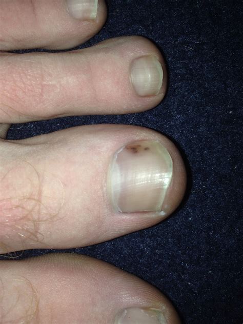Doctors share symptoms and what to look for on fingernails and toenails. toe nail melanoma - pictures, photos