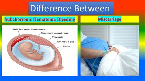 Distinction Between Subchorionic Hematoma Bleeding And Miscarriage