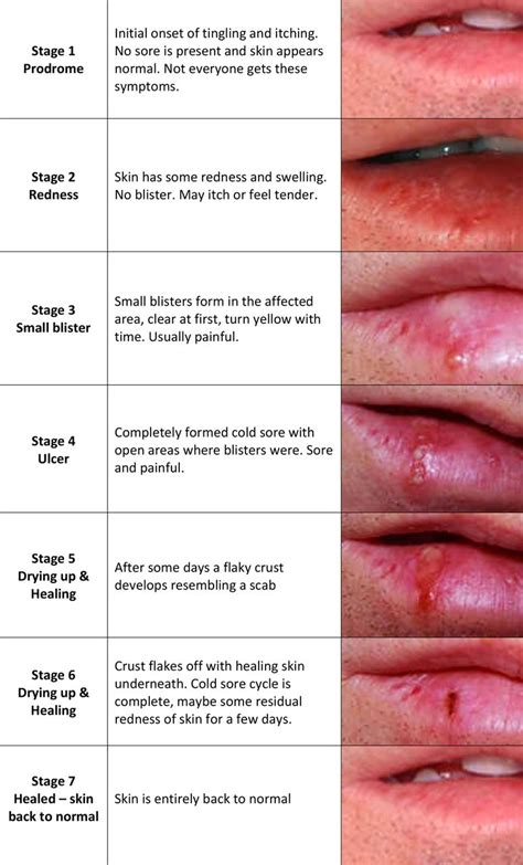 Stages Of Cold Sores On Lips Pictures