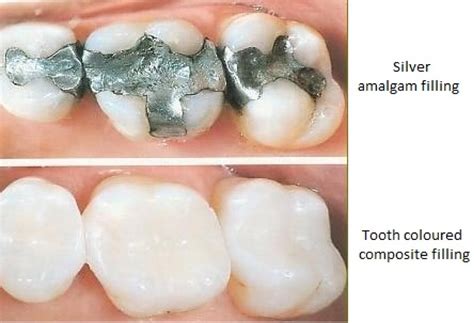 Why Do Dentists Prefer Composite Fillings Chandler Dental Center Tx