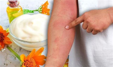 Eczema Treatment Prevent Dry And Itchy Skin With A Calendula Cream