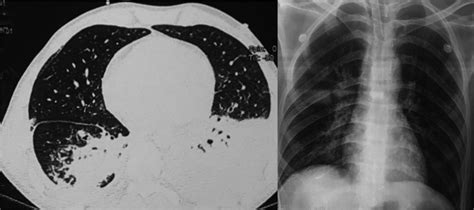 Chest X‐ray And Ct Scan Showing Basal Consolidation In Both Lung Fields