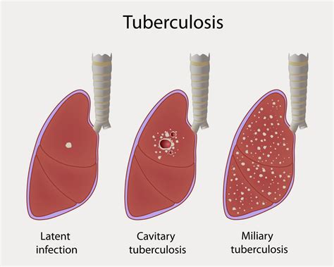 Tuberculosis Health And Disease