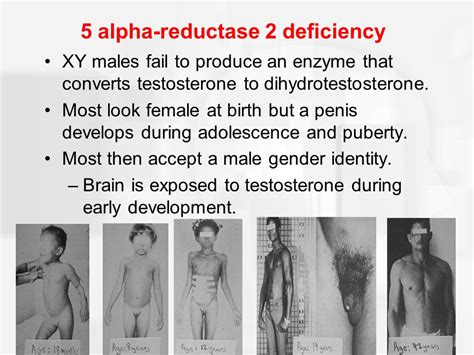 5 alpha reductase deficiency slide share