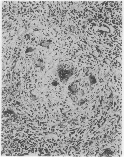 One Of The Many Non Caseating Sarcoidal Giant Cell Granulomas