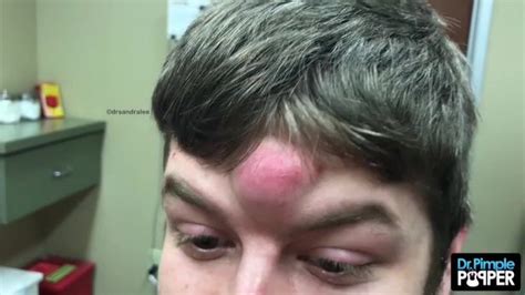 Dr Pimple Popper Removes Huge Unicorn Cyst From Mans Forehead In Stomach Churning Procedure