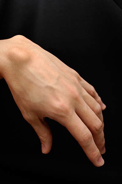 Ganglion Cyst Wrist Symptoms Causes Pictures Treatment Healthmd