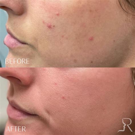 Zo Skin Health Before And Afters Roberts Aesthetics And Wellness