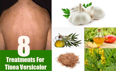 8 Natural Treatments For Tinea Versicolor How To Treat Tinea