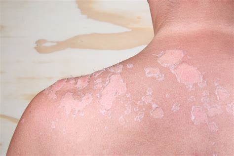 5 Signs Of Sun Poisoning Since Its Not The Same Thing As Sunburn