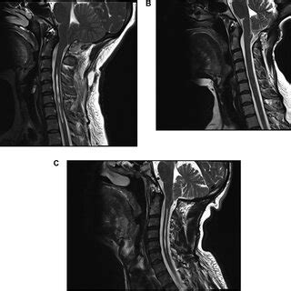 A Preoperative Sagittal T Weighted MRI Image Of A Patient With CM Download Scientific