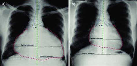 Tuberculous Pericarditis Chest Radiograph A Severe Pericardial