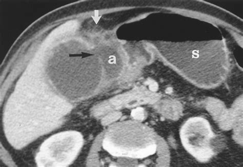 Ct Findings In Acute Gangrenous Cholecystitis Ajr