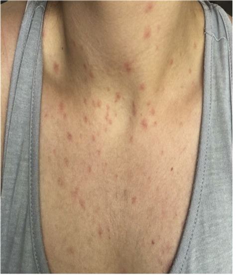 Mild Measles Rash