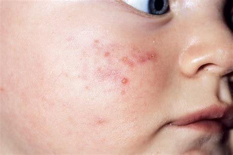 Newborn And Baby Skin Spots And Rashes Madeformums