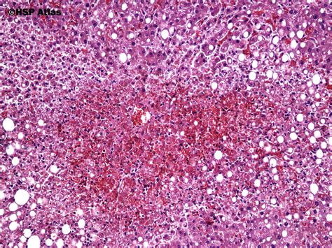 Nutmeg Liver Histology