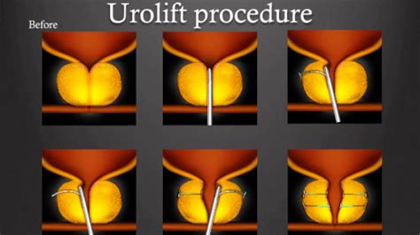 Urolift Vs Greenlight Therapy For Bph What S Right For You Youtube