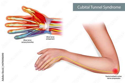 Obraz Medical Illustration To Explain Cubital Tunnel Syndrome Ulnar