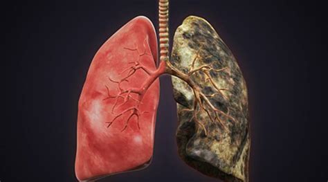 Watch Lungs Of Smokers Vs Non Smokers This Viral Video Shows The Real