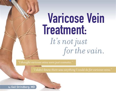 Varicose Vein Treatment Northpointe Medical