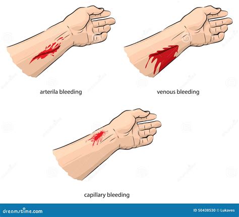 Bleeding Stock Vector Illustration Of Hand Circulation 50438530