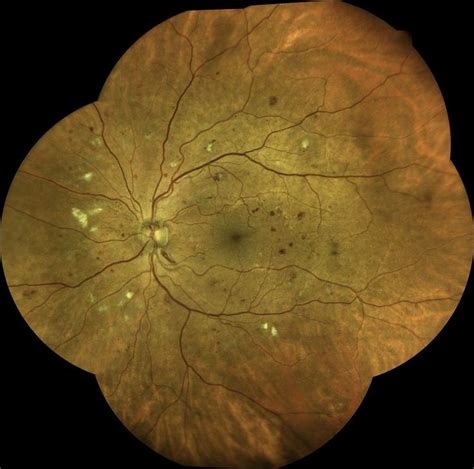In this study, no patients with a single blot haemorrhage. Figure 2. Moderate nonproliferative diabetic retinopathy ...