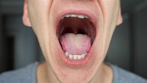 What Does Mouth Cancer Look Like On Tongue