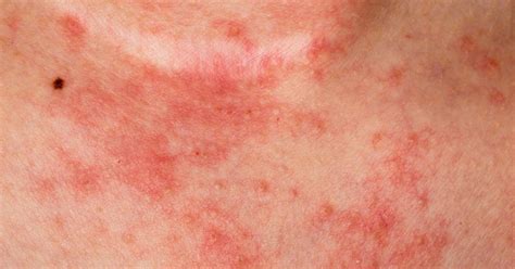 6 Tipos De Eczema Sintomas E Causas Respostas Sempre Atualizadas