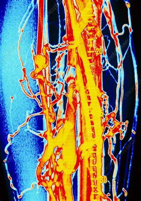 Coloured Venogram Of Phlebitis In Leg Of Patient Stock Image M175
