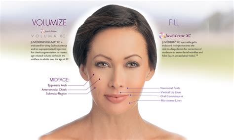 Juvederm Voluma For Youthful Contoured Cheeks San Diego Cosmetic