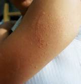 Home Remedies Scabies Humans Images