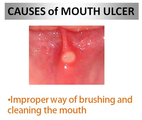 Mouth Ulcers Causes Symptoms And Treatment