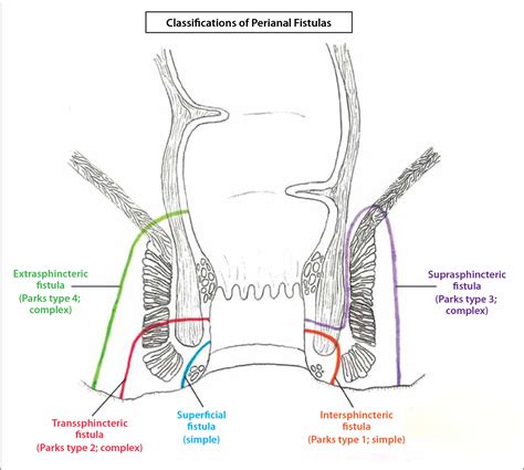 Figure From Perianal Fistulas In Patients With Crohn S Disease Part Current Medical