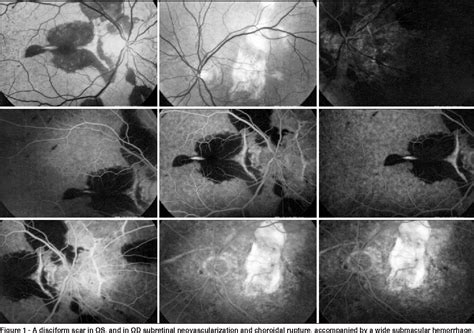 Figure 1 From Intravitreal Bevacizumab In Choroidal Neovascularization