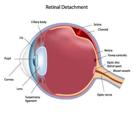 Surgery is done to repair a detached retina. Floaters In The Eye: Should You Be Panicking? - endmyopia.org