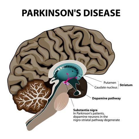 Life At Optimal With Dr John Bartemus Parkinsons Disease Vs