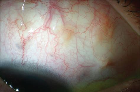 Conjunctival Granulomatosis In Churg Strauss Syndrome Allergy And