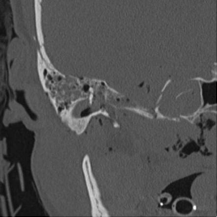 Temporal Bone Fracture Radiology Reference Article Radiopaedia Org