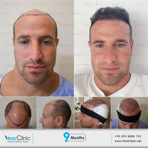 Mr Manuel Calderon From Spain Did Hair Transplantation At Vera Clinic